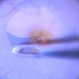 ILM Peeling in a Case of Macular Hole ILM Peeling in a Case of Macular Hole