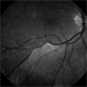 Branch Retinal Artery Occlusion