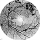 Proliferative Diabetic Retinopathy Inverted