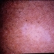 Tuberous Sclerosis Tuberous Sclerosis