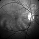 Preeclampsia in a 30-Year-Old  - Red Free Photograph - RE Preeclampsia in a 30-Year-Old  - Red Free Photograph - RE