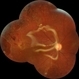 Relaxing Retinectomy