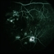 BDR / Macular Edema / Macroaneurysm BDR / Macular Edema / Macroaneurysm