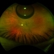 Pneumatic Retinopexy Pneumatic Retinopexy