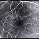Telangiectasia Telangiectasia