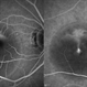 Central Serous Retinopathy