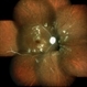 SLE Retinopathy SLE Retinopathy