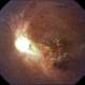 Lupus Retinopathy