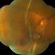Posterior Retinal Folds Posterior Retinal Folds