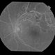 BRVO With Non-perfusion