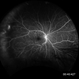 Telangiectasia 3 Telangiectasia 3