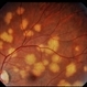 Pneumocystis Carinii Choroiditis Pneumocystis Carinii Choroiditis