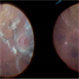 VPT intra-operative cryotherapy