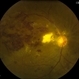 Combined Artery and Vein Occlusion Combined Artery and Vein Occlusion