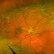 Ocular Hypotony Due to Leaking Bleb Ocular Hypotony Due to Leaking Bleb