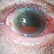 Silicone Oil In Anterior Chamber With Hyphema