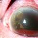Silicone Oil In Anterior Chamber With Hyphema