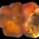 Pigmented Peripheral Retinal Degeneration
