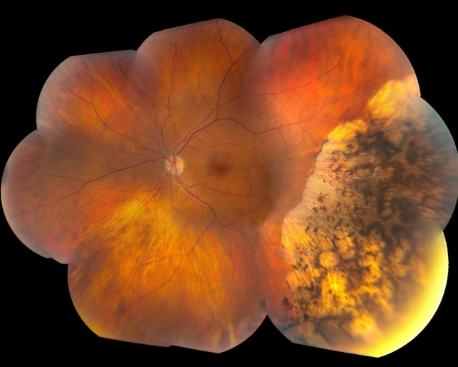 Pigmented Peripheral Retinal Degeneration - Retina Image Bank