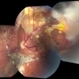 Retinal Capillary Hemangioma Due to Von Hippel-Lindau Syndrome