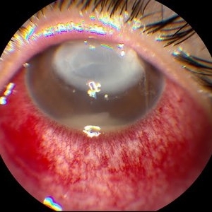 Endophthalmitis - Retina Image Bank