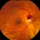Superior Peripapillary Hemorrhage