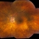 Sarcoid Uveitis