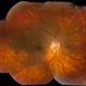 Sarcoid Uveitis