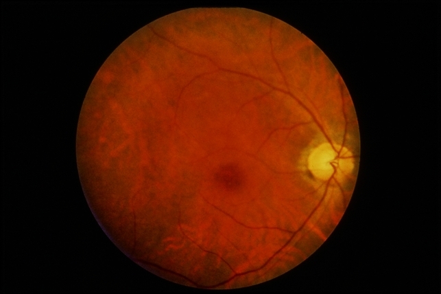 Snowflake Disorder Snowflake Vitreoretinal Degeneration – LOAG