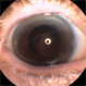 Dislocated Posterior Chamber Intraocular Lens (PCIOL)
