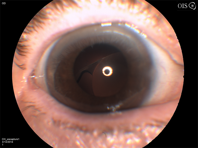 dislocated iol (intraocular lens) posterior left icd 10