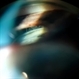 Goinoscopy of Zonules