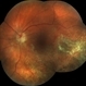 CMV retinitis/ After treatment CMV retinitis/ After treatment