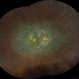 Bietti's Crystalline Dystrophy Bietti's Crystalline Dystrophy