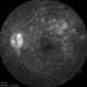 acute posterior multifocal placoid pigment epitheliopathy acute posterior multifocal placoid pigment epitheliopathy