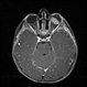 MRI: The Preferred Method to Image the Brain and Orbit of Children with Retinoblastoma MRI: The Preferred Method to Image the Brain and Orbit of Children with Retinoblastoma