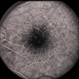 X-Linked Retinoschisis / Female X-Linked Retinoschisis / Female