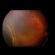 Retinopathy of Prematurity Stage 4a
