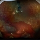 Diabetic Tractional Retinal Detachment 1 week s/p SO fill Diabetic Tractional Retinal Detachment 1 week s/p SO fill