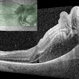 OCT Montage: Choroidal Aspergilloma With Secondary Choroidal Neovascularization and Exudative Retinal Detachment OCT Montage: Choroidal Aspergilloma With Secondary Choroidal Neovascularization and Exudative Retinal Detachment