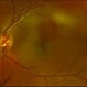 HTN Retinopathy with Pre-Papillary Vascular Loop OS HTN Retinopathy with Pre-Papillary Vascular Loop OS