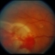 Retinal Capillary Hemangioblastoma Retinal Capillary Hemangioblastoma