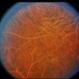 Hyperlipidemia