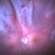 Retinal Detachment Retinal Detachment