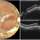 Macular Pseudo-Hole in a Buckled Eye Macular Pseudo-Hole in a Buckled Eye