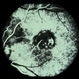 ToxocaraGgranuloma ToxocaraGgranuloma