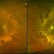 Macular Degeneration with Significant Drusen Macular Degeneration with Significant Drusen