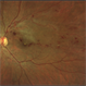 Branch retinal vein occlusion - Colour & Red free image - ring shaped collaterals