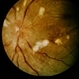 HTN / Macular Star / CWS HTN / Macular Star / CWS