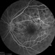 Acute posterior multifocal placoid pigment epitheliopathy (APMPPE) Acute posterior multifocal placoid pigment epitheliopathy (APMPPE)